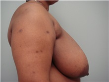 Breast Reduction Before Photo by Richard Greco, MD; Savannah, GA - Case 30652