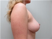 Breast Reduction After Photo by Richard Greco, MD; Savannah, GA - Case 31470