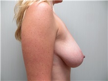 Breast Reduction Before Photo by Richard Greco, MD; Savannah, GA - Case 31470