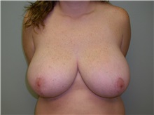 Breast Reduction After Photo by Richard Greco, MD; Savannah, GA - Case 31471