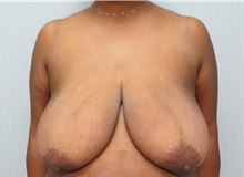 Breast Reduction Before Photo by Richard Greco, MD; Savannah, GA - Case 31472