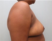 Breast Reduction After Photo by Richard Greco, MD; Savannah, GA - Case 31472