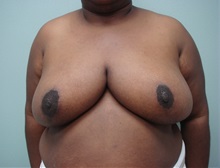 Breast Reduction After Photo by Richard Greco, MD; Savannah, GA - Case 31475