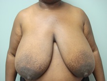 Breast Reduction Before Photo by Richard Greco, MD; Savannah, GA - Case 31475