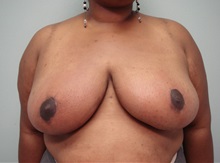 Breast Reduction After Photo by Richard Greco, MD; Savannah, GA - Case 31476
