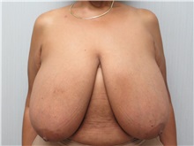 Breast Reduction Before Photo by Richard Greco, MD; Savannah, GA - Case 31477