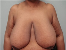 Breast Reduction Before Photo by Richard Greco, MD; Savannah, GA - Case 31479