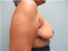 Breast Reduction After Photo by Richard Greco, MD; Savannah, GA - Case 31479