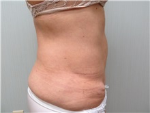 Liposuction After Photo by Richard Greco, MD; Savannah, GA - Case 31895