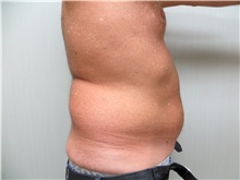 Liposuction Before Photo by Richard Greco, MD; Savannah, GA - Case 31905
