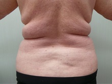 Liposuction Before Photo by Richard Greco, MD; Savannah, GA - Case 31907