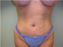Liposuction After Photo by Richard Greco, MD; Savannah, GA - Case 31908
