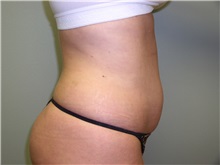 Liposuction Before Photo by Richard Greco, MD; Savannah, GA - Case 31908