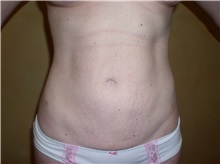 Liposuction After Photo by Richard Greco, MD; Savannah, GA - Case 31911