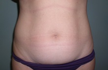 Liposuction Before Photo by Richard Greco, MD; Savannah, GA - Case 31912