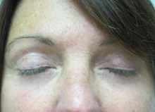 Eyelid Surgery After Photo by Richard Greco, MD; Savannah, GA - Case 31917