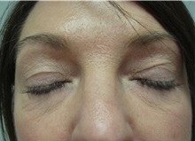 Eyelid Surgery Before Photo by Richard Greco, MD; Savannah, GA - Case 31917