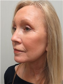 Facelift After Photo by Richard Greco, MD; Savannah, GA - Case 36407