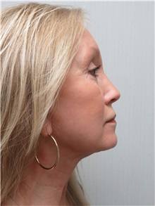 Facelift After Photo by Richard Greco, MD; Savannah, GA - Case 36407