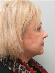 Facelift After Photo by Richard Greco, MD; Savannah, GA - Case 36413