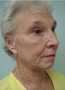 Facelift After Photo by Richard Greco, MD; Savannah, GA - Case 36420
