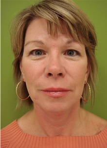 Facelift After Photo by Richard Greco, MD; Savannah, GA - Case 36422