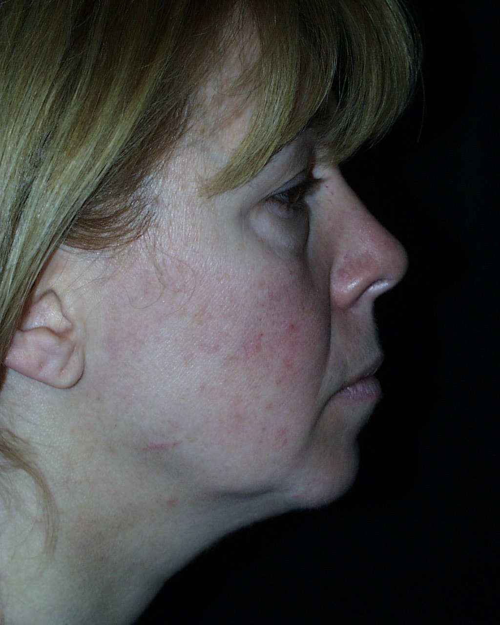 Facelift Before and After Photos by David Lange, MD; Mendham, NJ - Case  7079 | ASPS