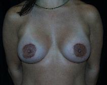 Breast Augmentation After Photo by David Lange, MD; Mendham, NJ - Case 7082