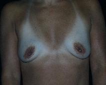 Breast Augmentation Before Photo by David Lange, MD; Mendham, NJ - Case 7082