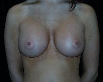 Breast Augmentation After Photo by David Lange, MD; Mendham, NJ - Case 7083
