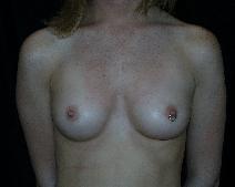 Breast Augmentation Before Photo by David Lange, MD; Mendham, NJ - Case 7083