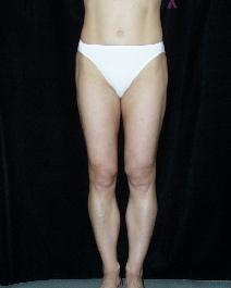 Liposuction After Photo by David Lange, MD; Mendham, NJ - Case 7086
