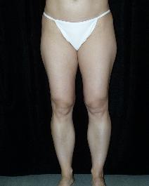Liposuction Before Photo by David Lange, MD; Mendham, NJ - Case 7086