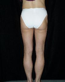 Liposuction After Photo by David Lange, MD; Mendham, NJ - Case 7086