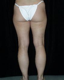 Liposuction Before Photo by David Lange, MD; Mendham, NJ - Case 7086
