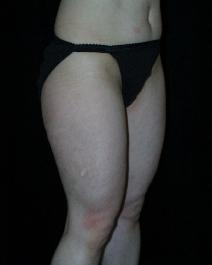Liposuction Before Photo by David Lange, MD; Mendham, NJ - Case 7087