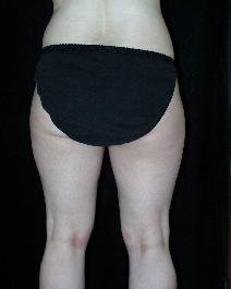 Liposuction Before Photo by David Lange, MD; Mendham, NJ - Case 7087