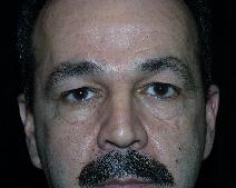 Eyelid Surgery Before Photo by David Lange, MD; Mendham, NJ - Case 7205