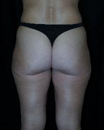 Liposuction Before Photo by David Lange, MD; Mendham, NJ - Case 7226