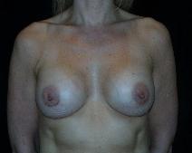 Breast Augmentation After Photo by David Lange, MD; Mendham, NJ - Case 7318