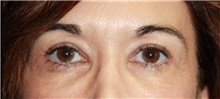 Eyelid Surgery After Photo by Leonard Miller, MD; Brookline, MA - Case 41147