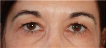 Eyelid Surgery Before Photo by Leonard Miller, MD; Brookline, MA - Case 41147