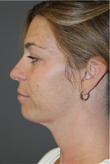 Liposuction After Photo by Leonard Miller, MD; Brookline, MA - Case 41148
