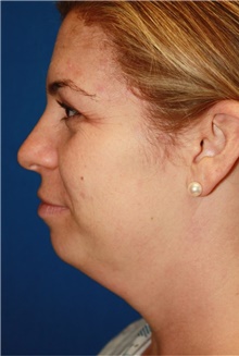 Liposuction Before Photo by Leonard Miller, MD; Brookline, MA - Case 41148