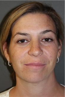 Liposuction After Photo by Leonard Miller, MD; Brookline, MA - Case 41148
