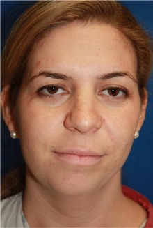 Liposuction Before Photo by Leonard Miller, MD; Brookline, MA - Case 41148