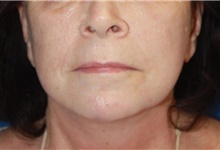 Neck Lift After Photo by Leonard Miller, MD; ,  - Case 41167