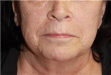 Neck Lift Before Photo by Leonard Miller, MD; ,  - Case 41167