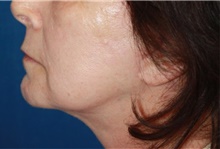 Neck Lift After Photo by Leonard Miller, MD; ,  - Case 41167