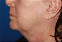 Neck Lift Before Photo by Leonard Miller, MD; ,  - Case 41167